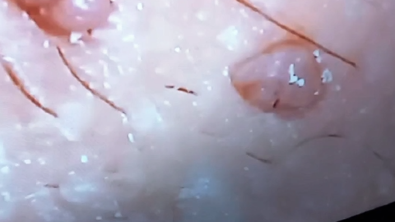 زگیل تناسلی در اطراف مقعد