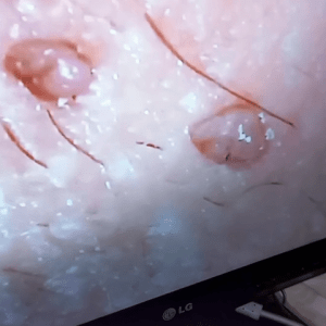 زگیل تناسلی در اطراف مقعد