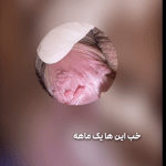 زگیل تناسلی در آقایان