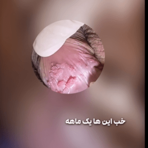 زگیل تناسلی در آقایان