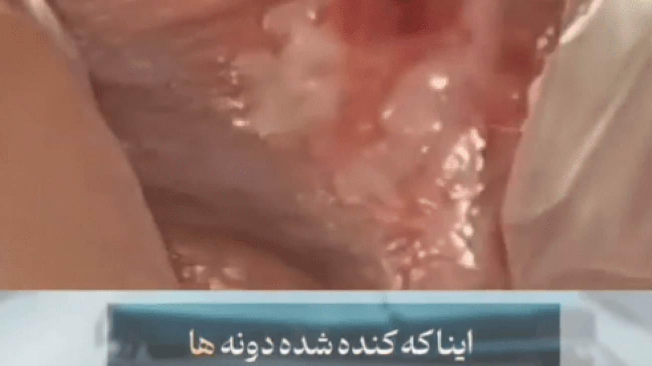 تشخیص تبخال تناسلی