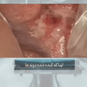 تشخیص تبخال تناسلی