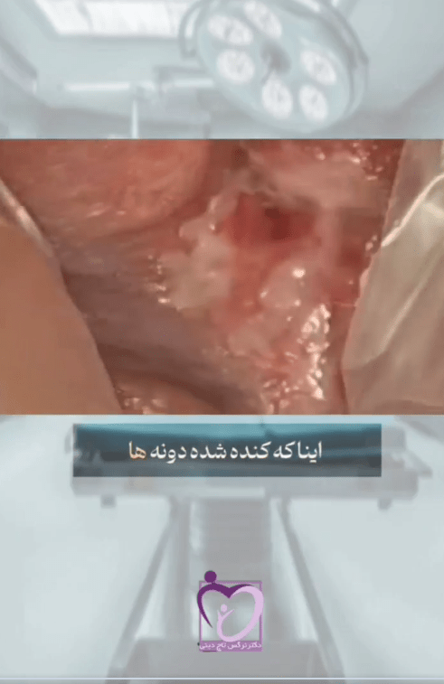 تشخیص تبخال تناسلی
